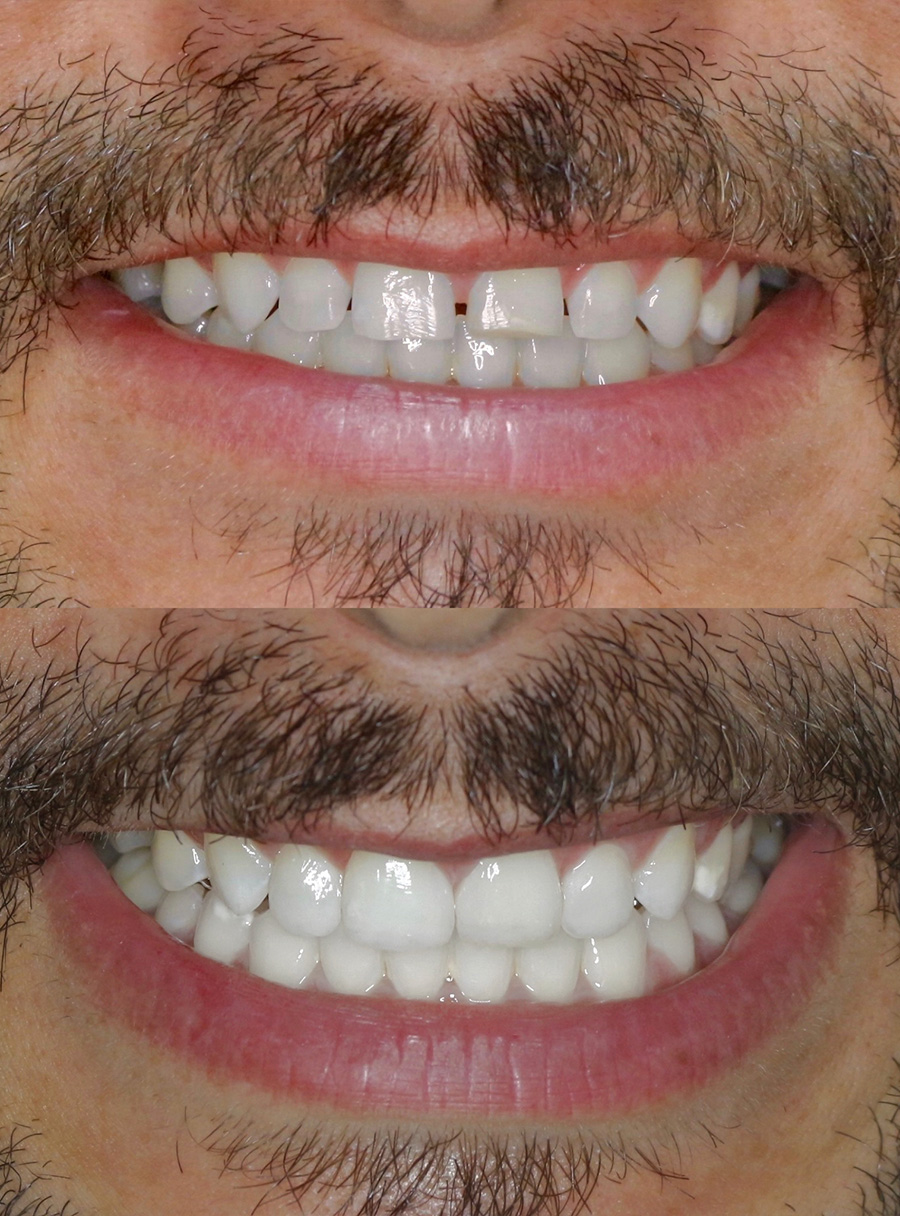 Transformação do sorriso com facetas em resina — caso 5