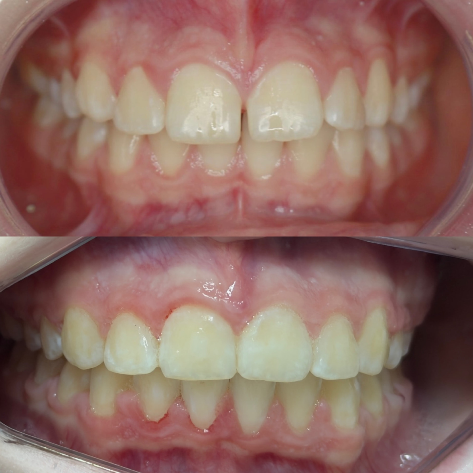 Detalhe de resultado odontológico — caso 6
