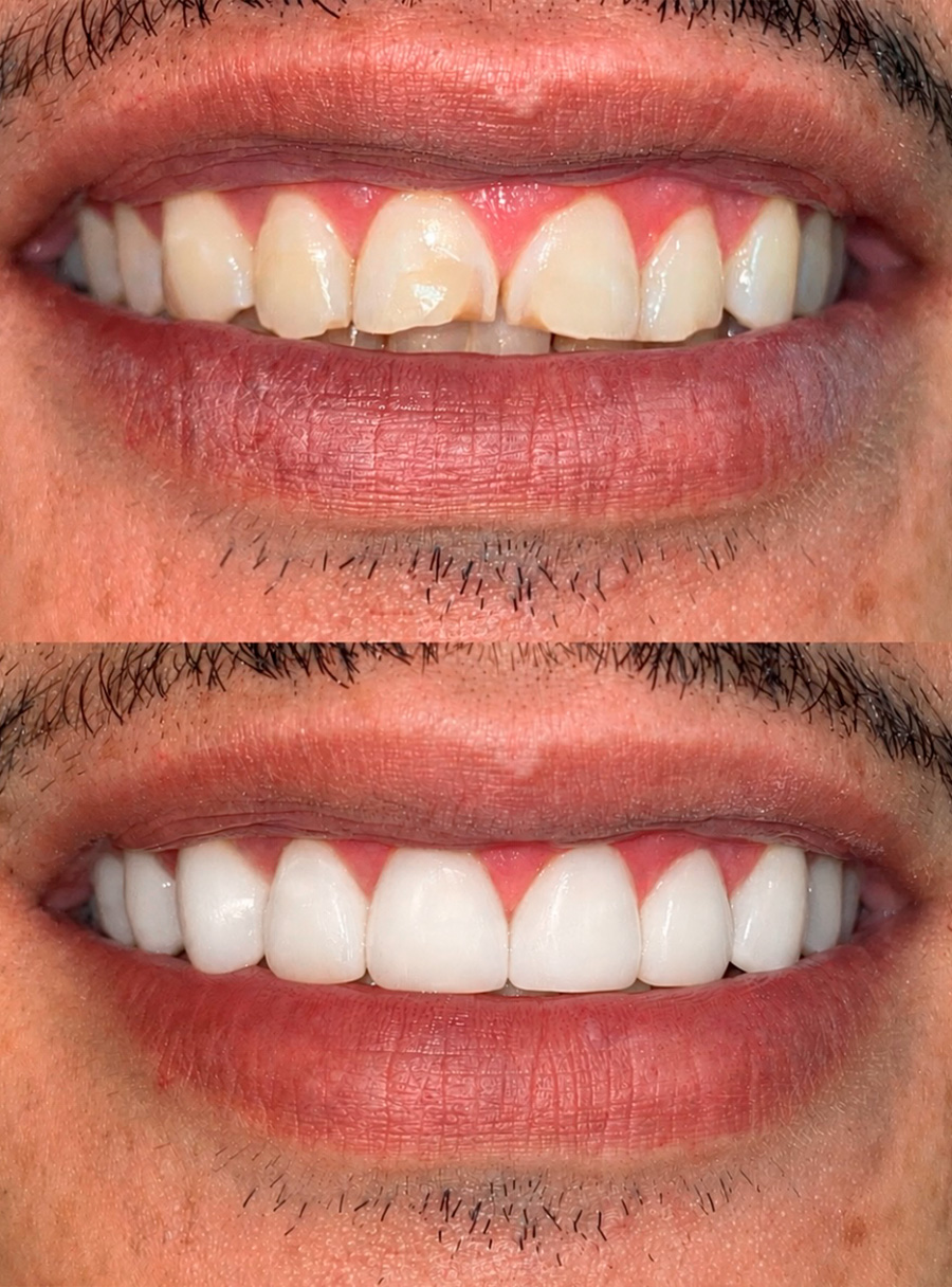 Transformação do sorriso com facetas em resina — caso 3