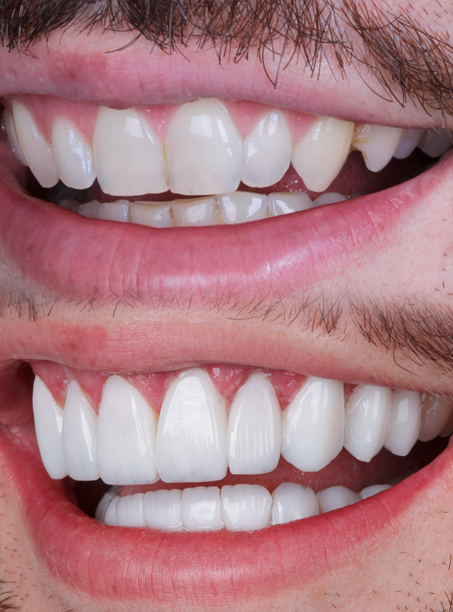 Transformação do sorriso com facetas em resina — caso 6