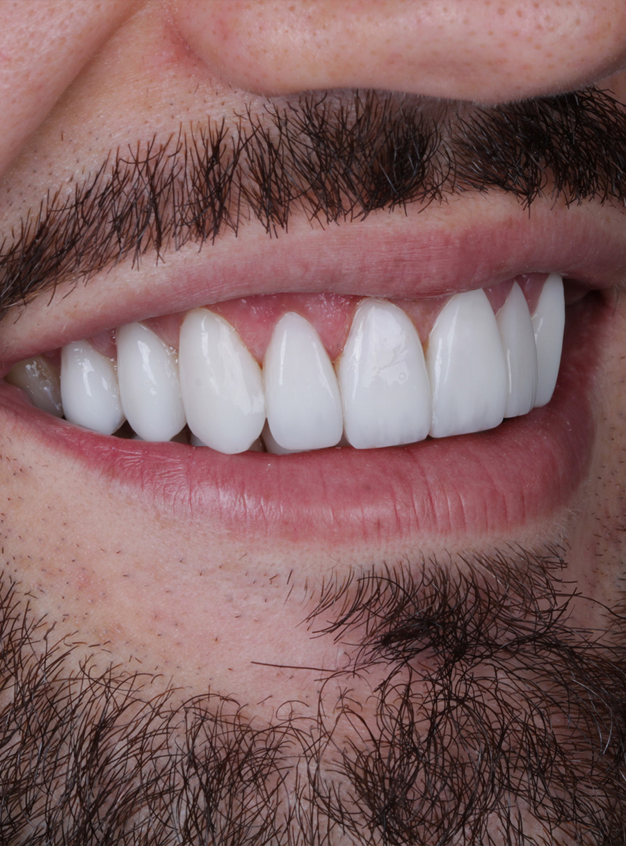 Transformação do sorriso com facetas em resina — caso 7