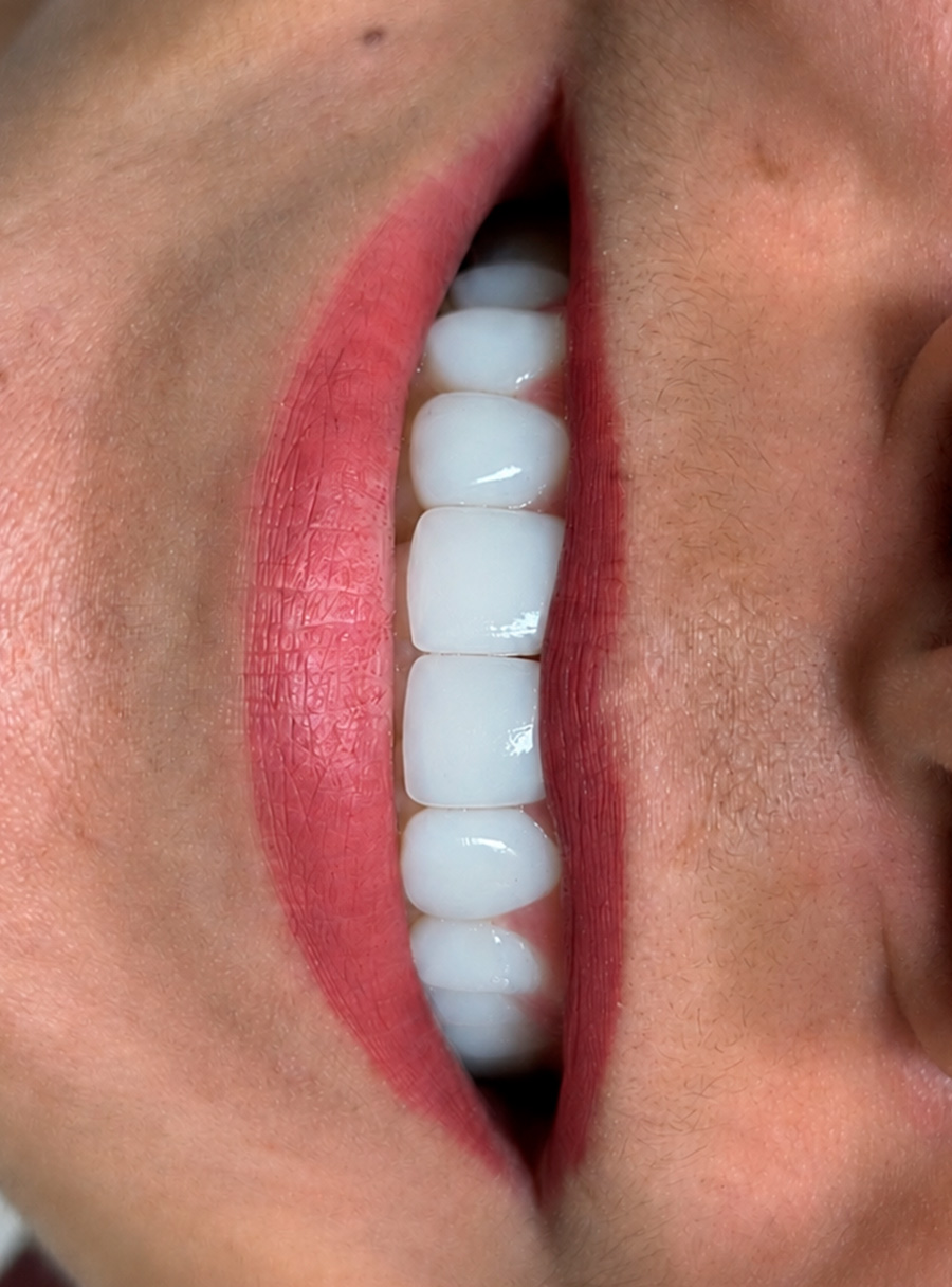 Transformação do sorriso com facetas em resina — caso 4