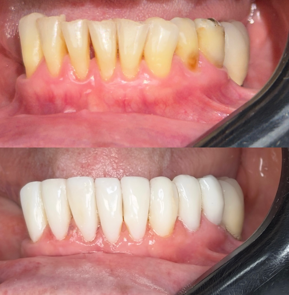 Detalhe de resultado odontológico — caso 2