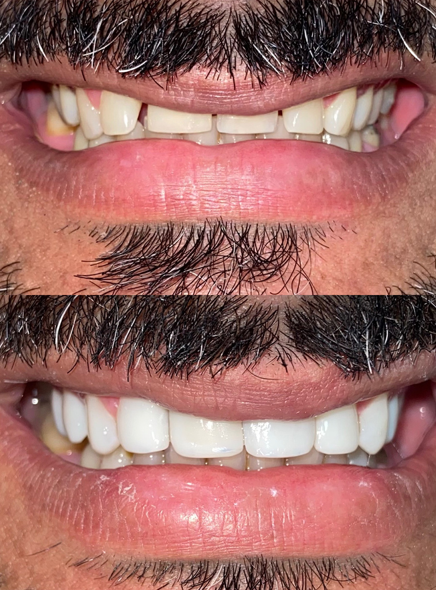 Transformação do sorriso com facetas em resina — caso 1