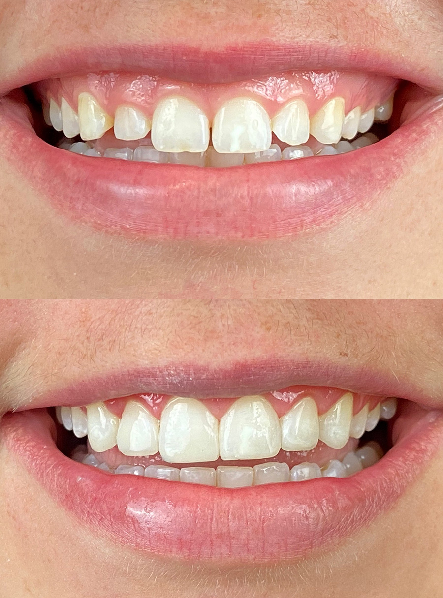Transformação do sorriso com facetas em resina — caso 2